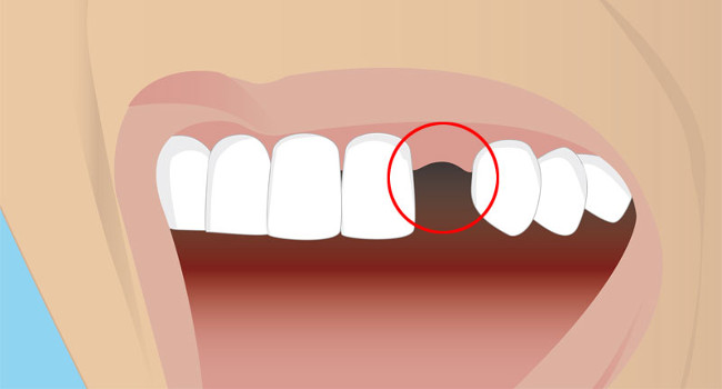 Grafik: Zahnlücke / fehlender Schneidezahn